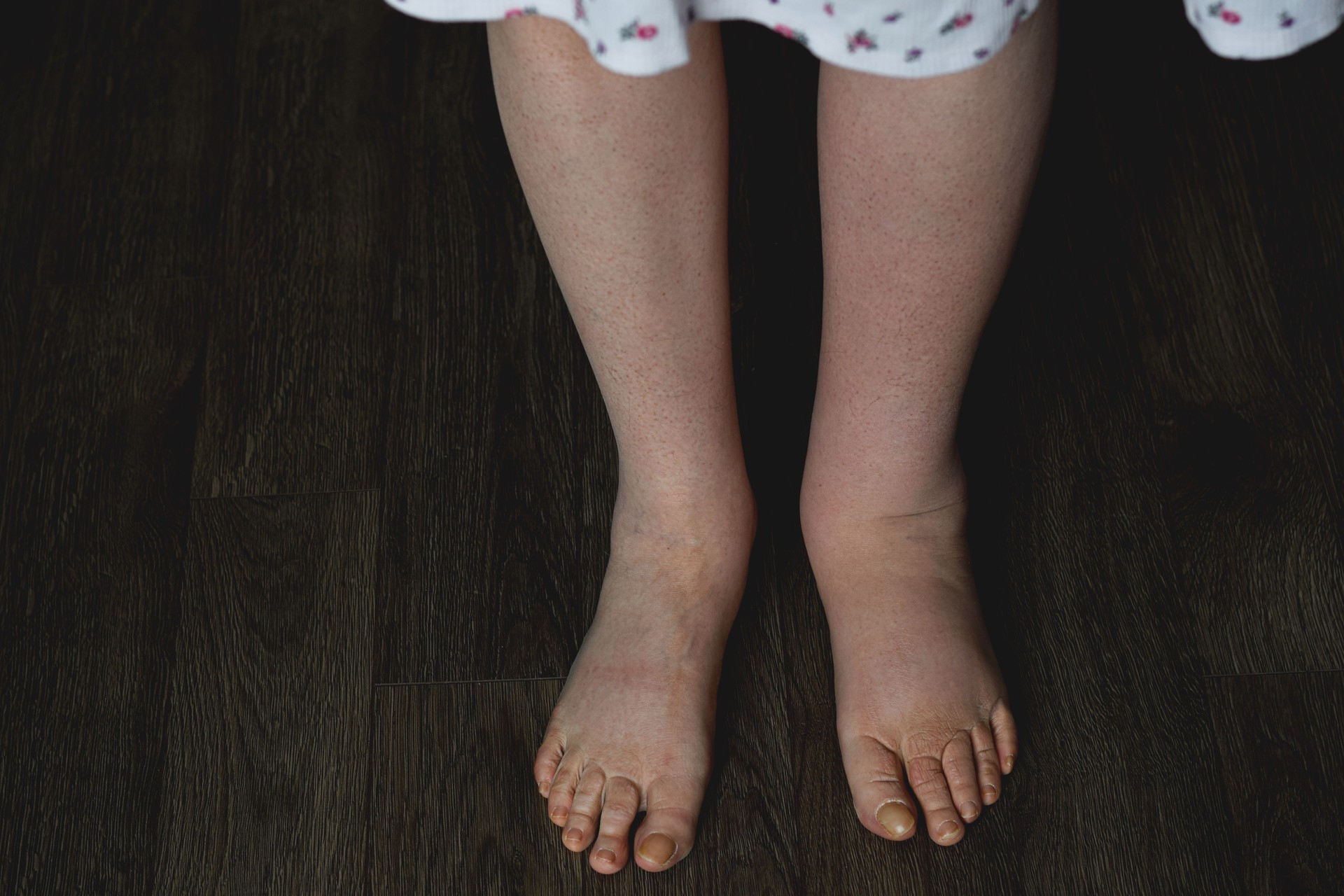 Swollen woman's feet with lymphedema condition