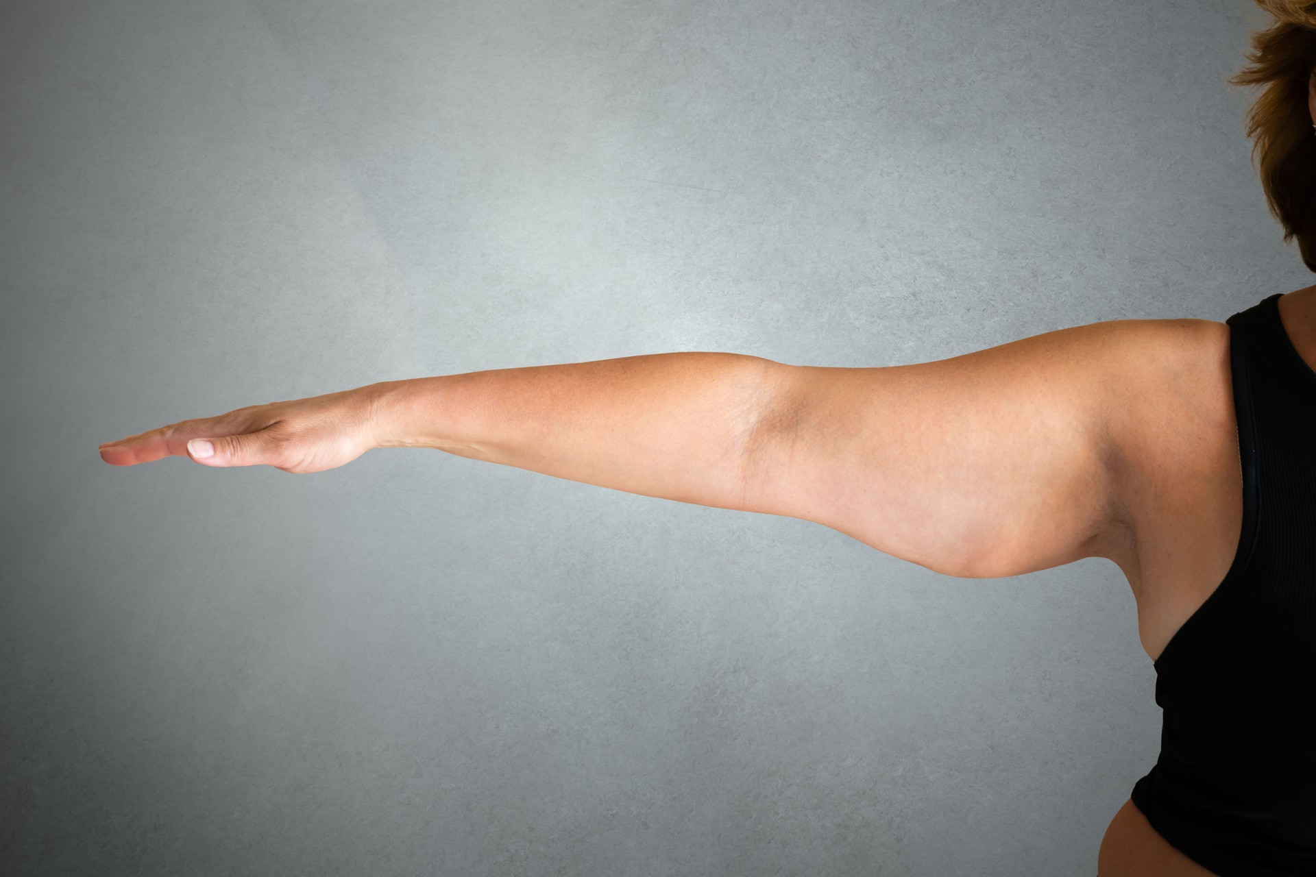 Lipedema