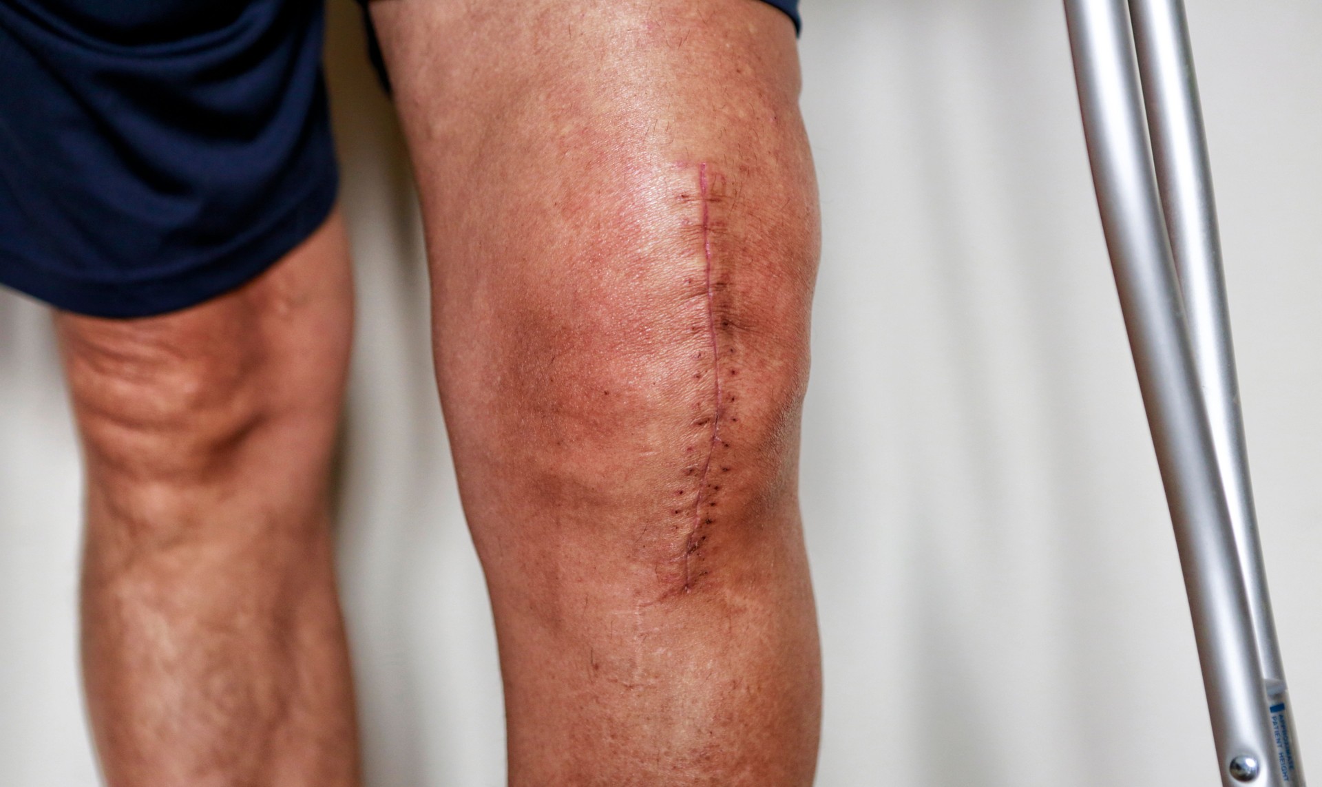 Edema after surgeries